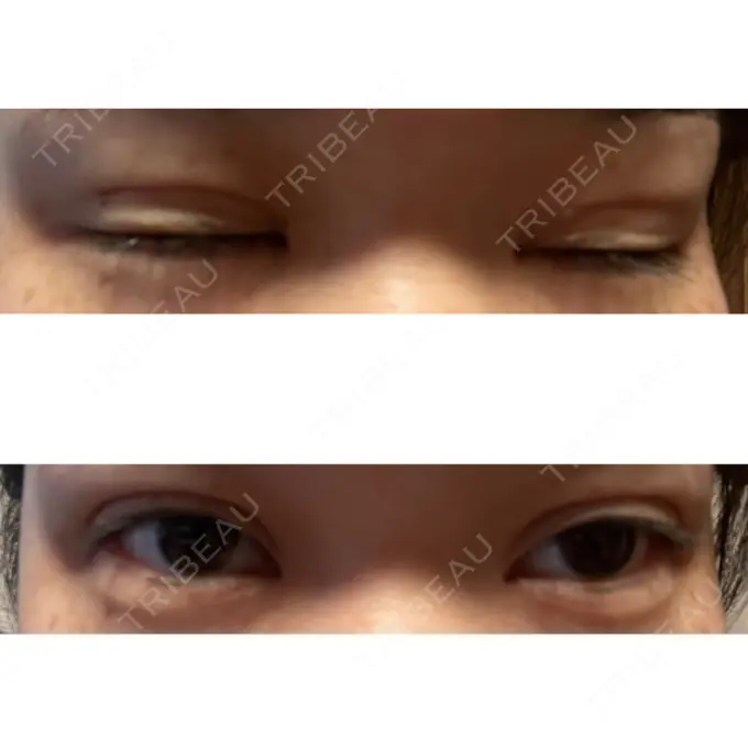 二重埋没 / 上まぶたの脂肪取り TCB東京中央美容外科 六本木院 BEFORE メイン用