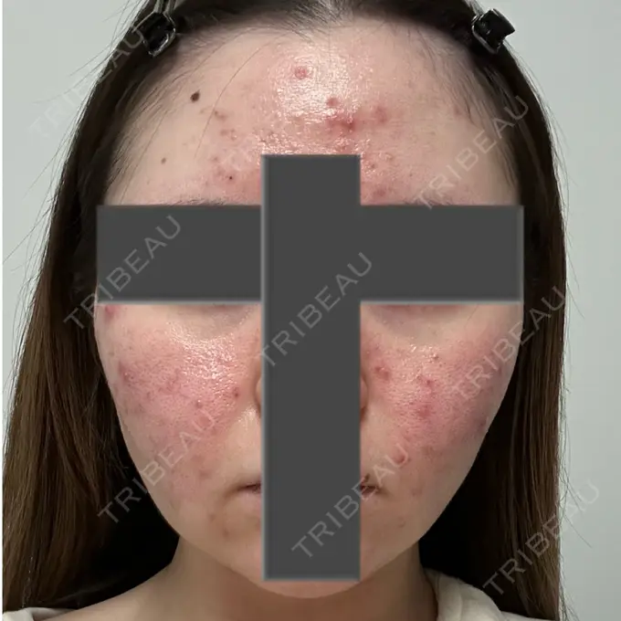 ニードルRF（ポテンツァなど） 東京美容外科 池袋院 BEFORE メイン用