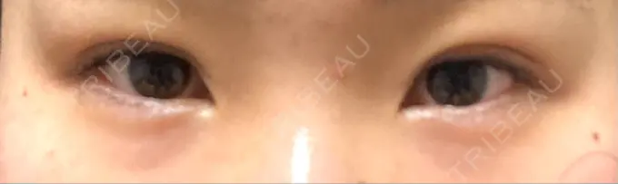 目頭切開 / クマ治療 / 目尻切開 / タレ目形成・グラマラスライン（切開） / 目尻靭帯移動 エターナル美容クリニック BEFORE メイン用