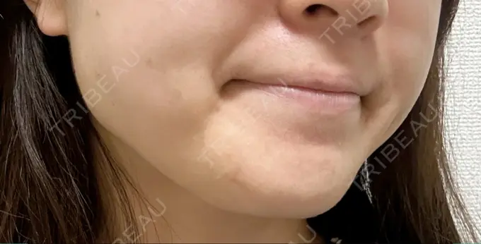 ボトックス（エラ・小顔） / 脂肪溶解注射（顔） CLINIC W BEFORE メイン用