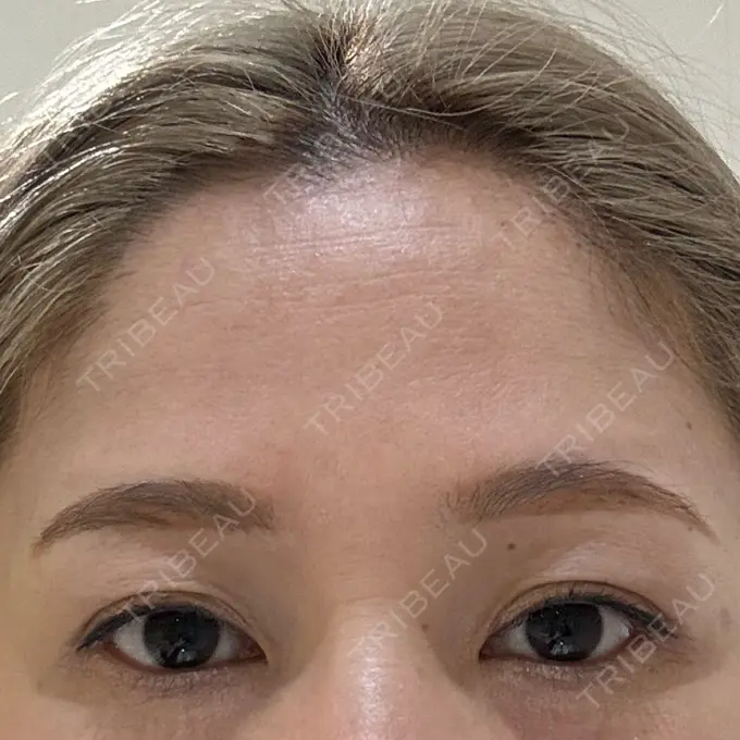 ヒアルロン酸注入（涙袋） / ボトックス（額） 渋谷美容外科クリニック 渋谷院 BEFORE メイン用