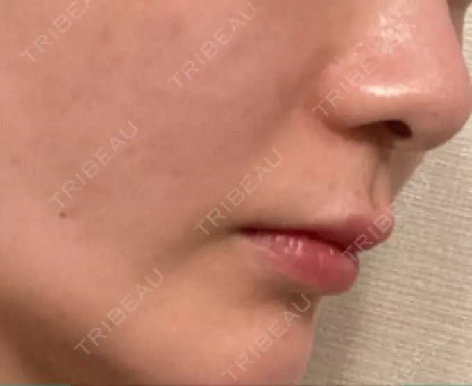 ヒアルロン酸注入（鼻翼基部） バログ医院 江南院 BEFORE メイン用