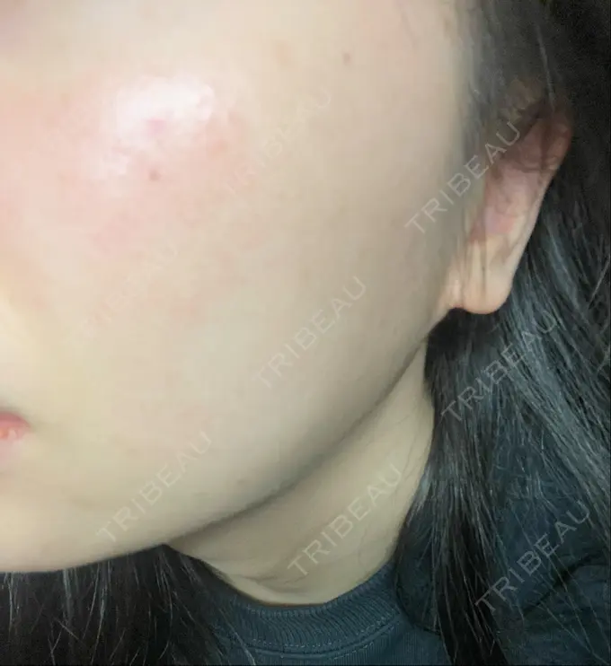 光治療（フォトフェイシャルなど） B-LINE CLINIC 池袋院 BEFORE メイン用