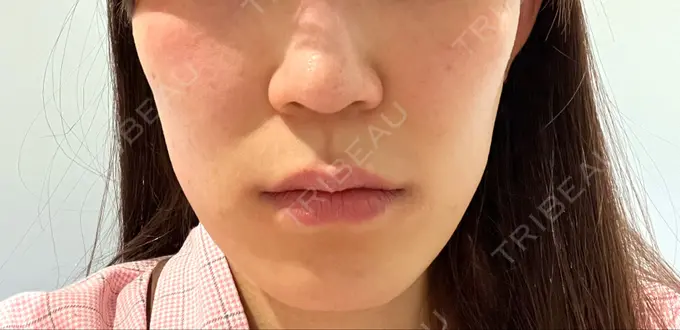 小鼻縮小（切開） / 人中短縮 Otus Clinic 【オータスクリニック】 BEFORE メイン用