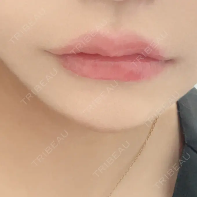 ヒアルロン酸注入（唇） / ボトックス（口角） L‘amour clinic Tokyo【ラムールクリニック東京】 BEFORE メイン用