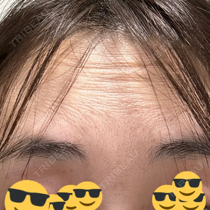 人中短縮 / ボトックス（あご） / ボトックス（目尻） / ボトックス（額） / その他（鼻） 湘南美容クリニック 岐阜院 BEFORE メイン用