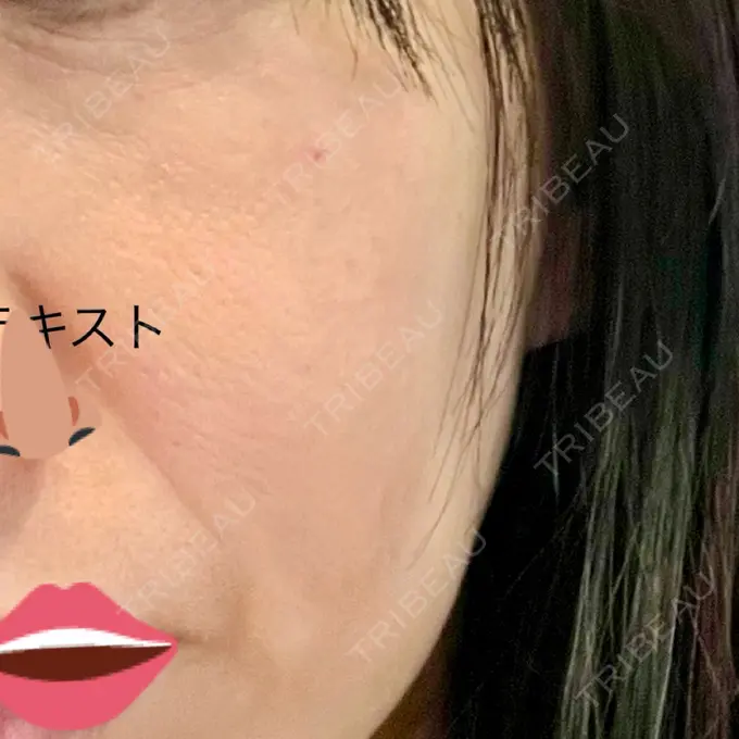 エレクトロポレーション A CLINIC（エークリニック） 福岡院 BEFORE メイン用