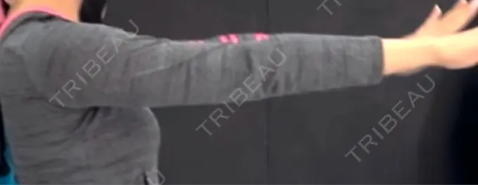 脂肪吸引（二の腕） / 脂肪吸引（脚） / 豊胸（脂肪注入） / 脂肪注入（額） / 脂肪吸引（肩） 湘南美容クリニック 銀座院 BEFORE メイン用