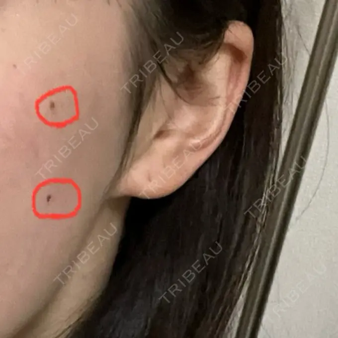 ほくろ・いぼ除去レーザー（肌） 白金ビークリニック 本院 BEFORE メイン用