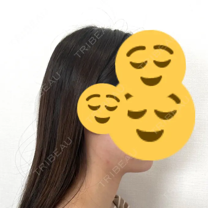 ボトックス（エラ・小顔） / ボトックス（肩） THE FIRST CLINIC 多摩センター院 BEFORE メイン用