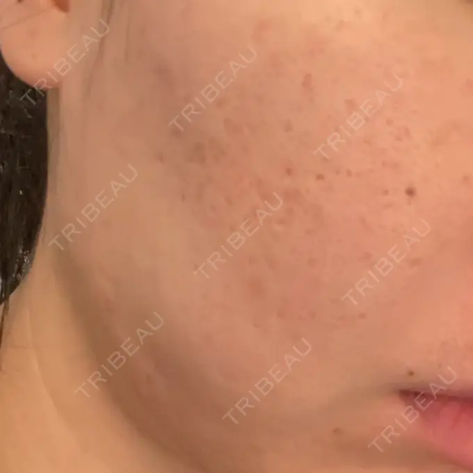 ヒアルロン酸注入（頬） / その他（肌） ゆきスキンクリニック 東池袋 BEFORE メイン用