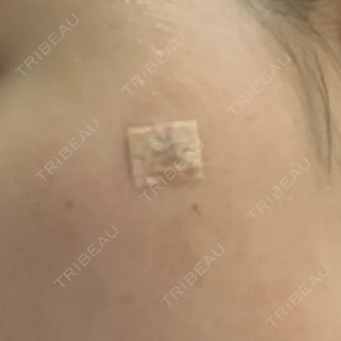 ほくろ・いぼ除去レーザー（肌） リッツ美容外科 大阪院 BEFORE メイン用