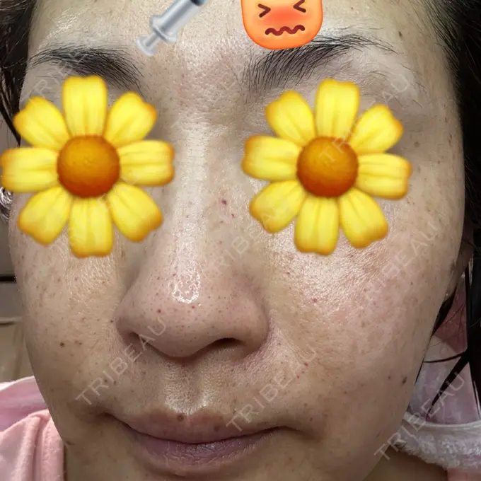 水光注射（ハリ・美肌） ARTE SKIN CLINIC 【アルテスキンクリニック】 BEFORE メイン用