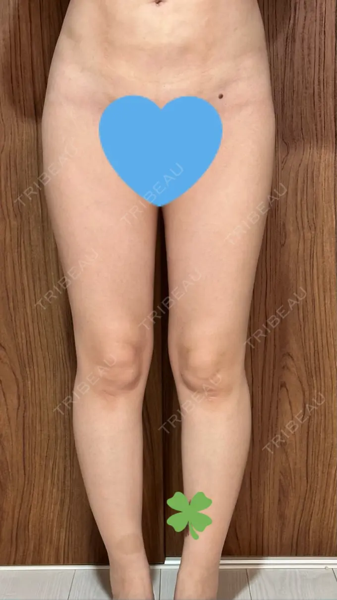 脂肪吸引（顔） / 脂肪吸引（脚） / 脂肪吸引（お尻） Mods Clinic（モッズクリニック） 福岡院 BEFORE メイン用