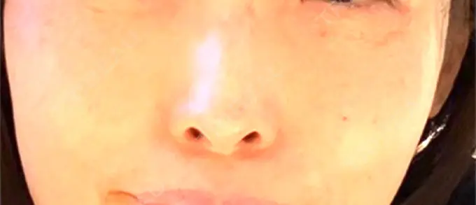 ルビーレーザー S-Laboクリニック 渋谷院 BEFORE メイン用