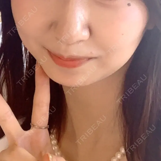 糸リフト / バッカルファット除去 / 脂肪吸引（顔） RIVER CLINIC（リバークリニック） BEFORE メイン用