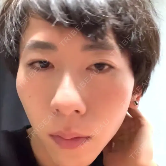 骨切り（あご） / 骨削り（エラ） / 骨削り（頬） id（アイディ）美容外科 BEFORE メイン用