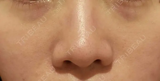 下まぶたの脂肪取り / 脂肪注入（目の下） eクリニック 岡山院 BEFORE メイン用