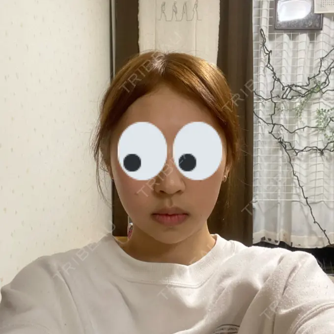 糸リフト / バッカルファット除去 / 脂肪吸引（顔） RIVER CLINIC（リバークリニック） BEFORE メイン用