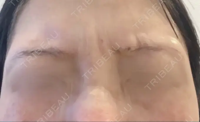 ボトックス（エラ・小顔） / シワ取りボトックス / ボトックス（眉間） / ボトックス（目尻） / ボトックス（額） TCB東京中央美容外科 立川院 BEFORE メイン用