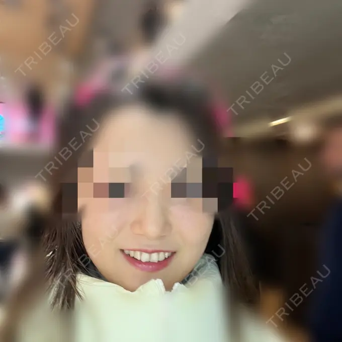 糸リフト / バッカルファット除去 / 脂肪吸引（顔） / ヒアルロン酸注入（鼻） / ボトックス（エラ・小顔） RIVER CLINIC（リバークリニック） BEFORE メイン用