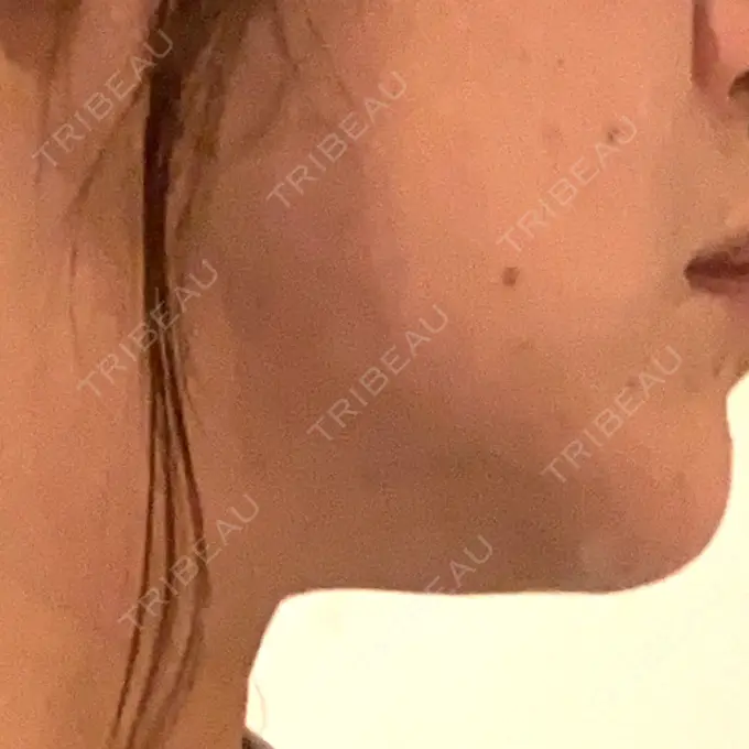 ボトックス（エラ・小顔） / 美容点滴・美容注射（ダイエット） / ハイフ（顔） S-Laboクリニック 渋谷院 BEFORE メイン用