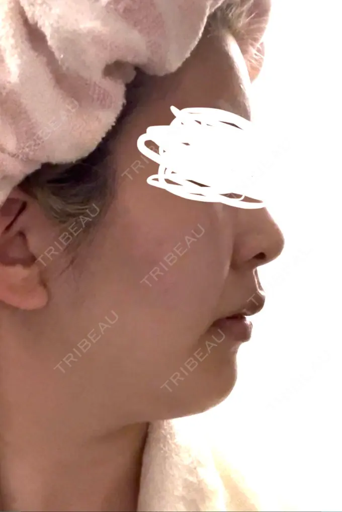 ハイフ（顔） Mavie Beauty Clinic （マヴィービューティークリニック） BEFORE メイン用