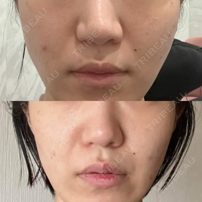 糸リフト Pono clinic 【ポノクリ】 BEFORE メイン用