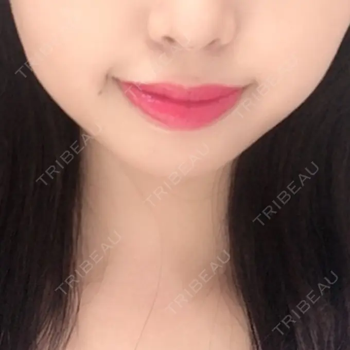 ヒアルロン酸注入（あご） TCB東京中央美容外科 新宿東口院 BEFORE メイン用