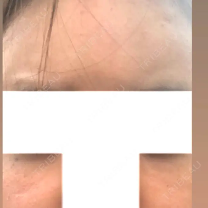 ヒアルロン酸注入（額） / ヒアルロン酸注入（頬） / ヒアルロン酸注入（鼻翼基部） LA CLEF CLINIC（ラクレクリニック） BEFORE メイン用