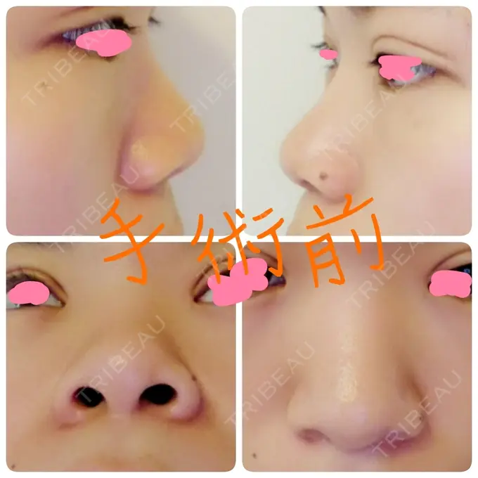 隆鼻術 / 鼻尖形成（切開） / 鼻尖縮小 ヤスミクリニック BEFORE メイン用