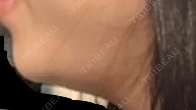 医療痩身（顔） リアルクリニック（REAL CLINIC） BEFORE メイン用