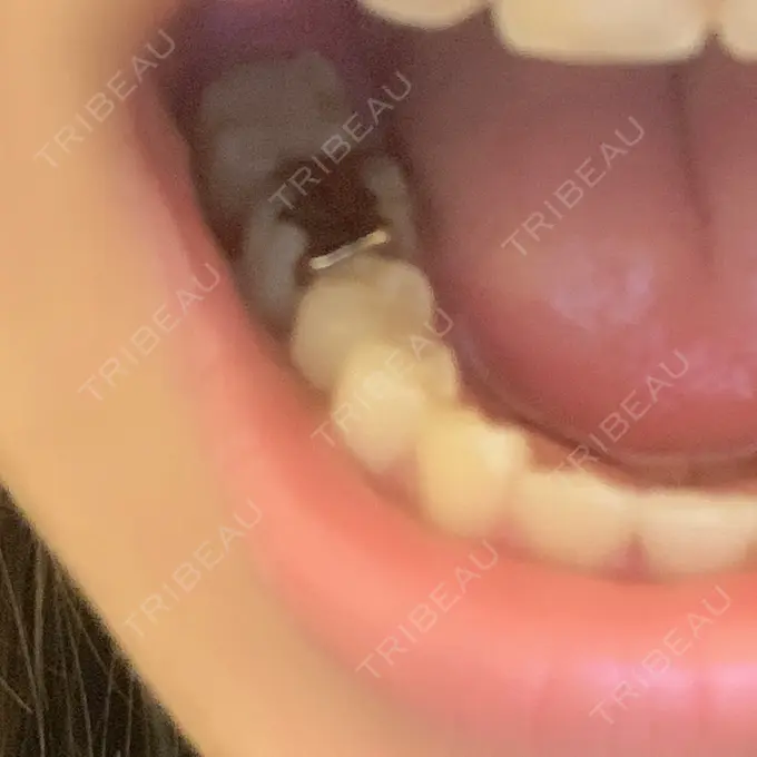 セラミック / その他（審美歯科/矯正歯科） 東京美容外科 赤坂院 BEFORE メイン用