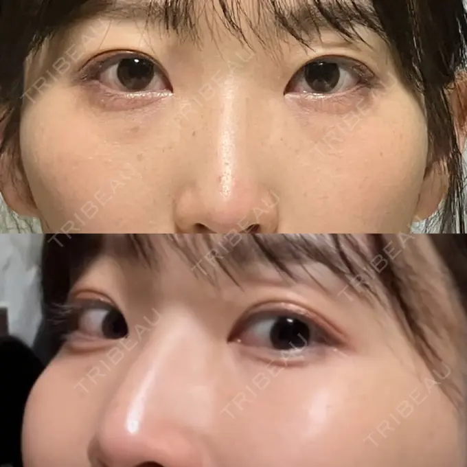 二重埋没 水の森美容クリニック 名古屋院 BEFORE メイン用