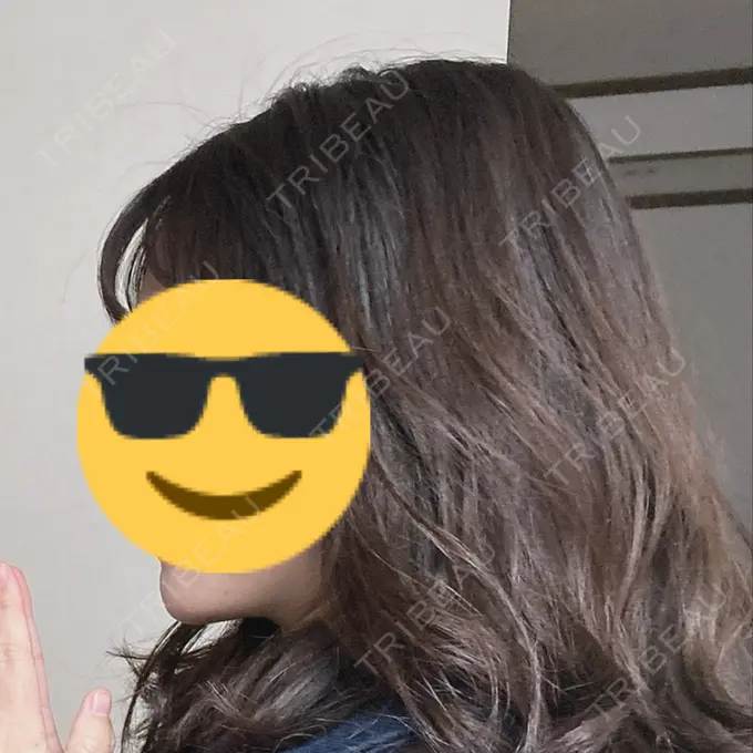 水光注射（ハリ・美肌） ARTE SKIN CLINIC 【アルテスキンクリニック】 BEFORE メイン用