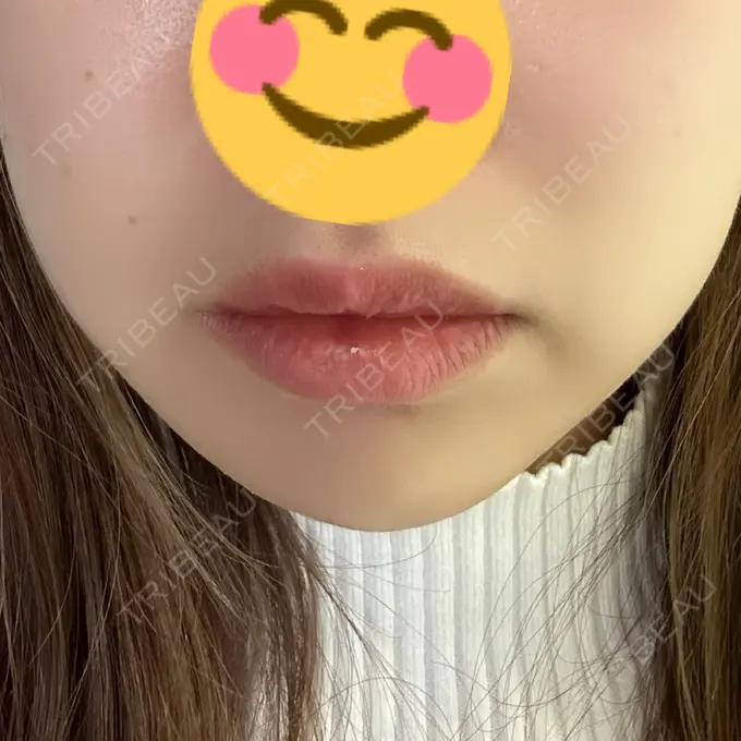 ボトックス（エラ・小顔） CLINIC W BEFORE メイン用