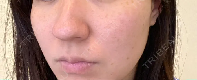 エレクトロポレーション / 毛穴洗浄（ハイドラフェイシャルなど） / 光治療（フォトフェイシャルなど） B-LINE CLINIC 池袋院 BEFORE メイン用