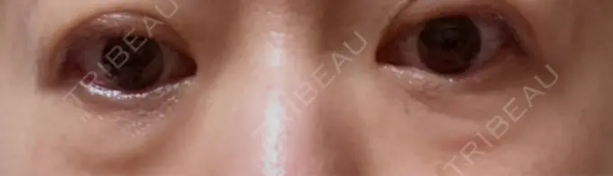 下まぶたの脂肪取り 東京イセアクリニック BEFORE メイン用