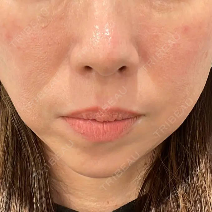 ピコレーザートーニング（美白・肝斑） / ピコフラクショナルレーザー（毛穴・ニキビ跡） G MEDICAL ART クリニック 新宿院 BEFORE メイン用