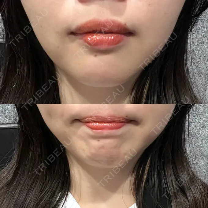 ボトックス（あご） LE CLINIC BEFORE メイン用