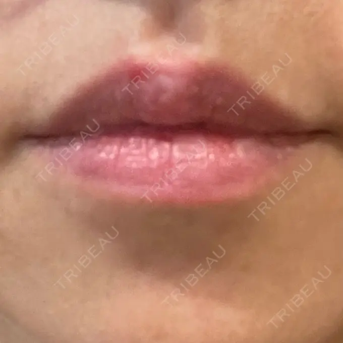 ヒアルロン酸注入（唇） ziz CLINIC BEFORE メイン用