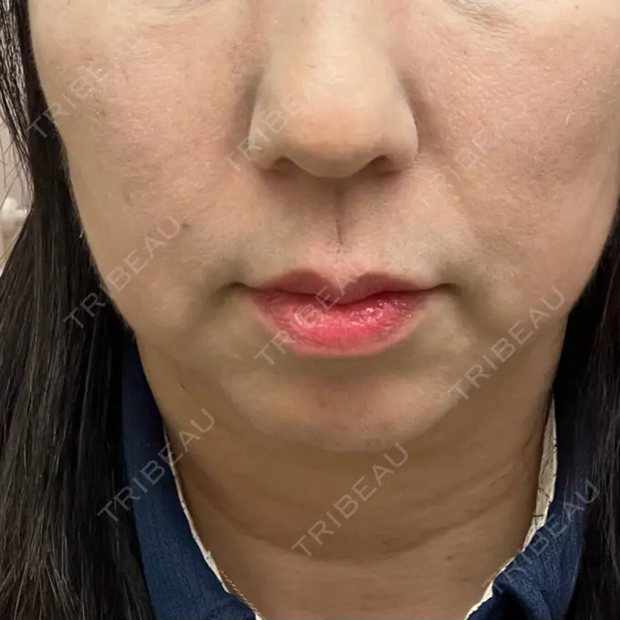 切開リフト 船橋中央クリニック BEFORE メイン用