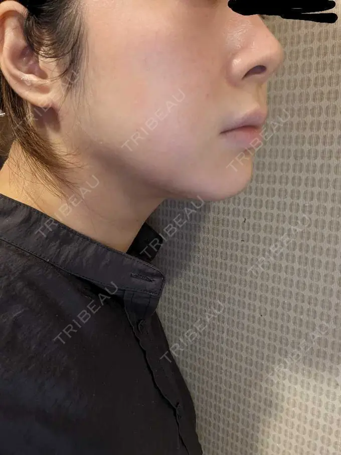 エレクトロポレーション / ルメッカ B-LINE CLINIC 池袋院 BEFORE メイン用