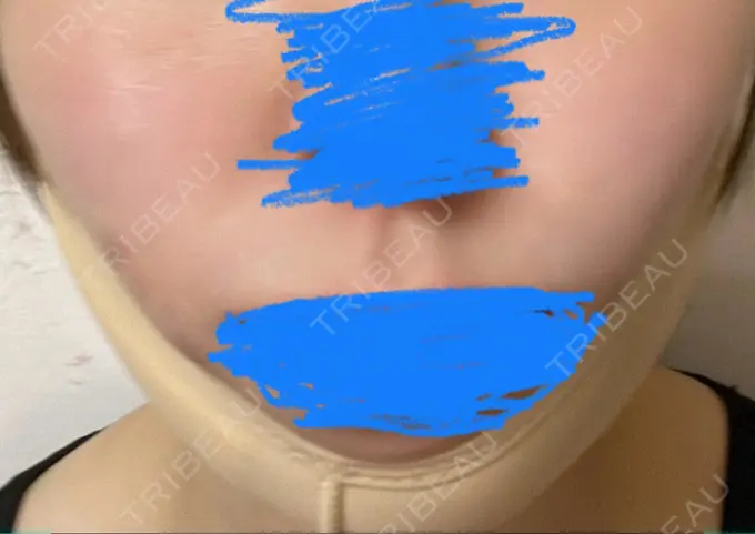 脂肪吸引（顔） yuzawa clinic BEFORE メイン用