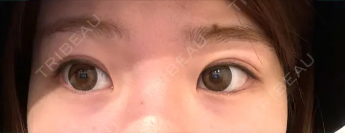 目尻切開 / 目尻靭帯移動 GLANZ CLINIC BEFORE メイン用