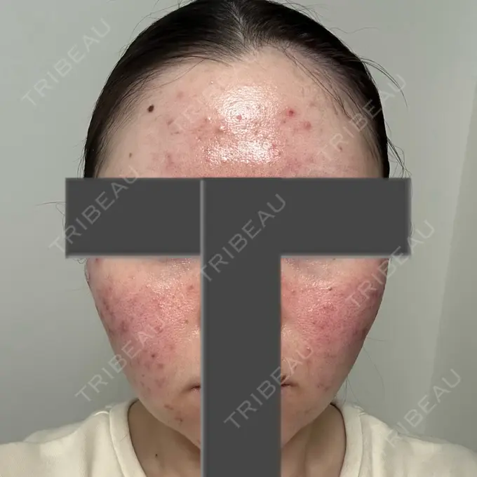 ニードルRF（ポテンツァなど） 東京美容外科 池袋院 BEFORE メイン用