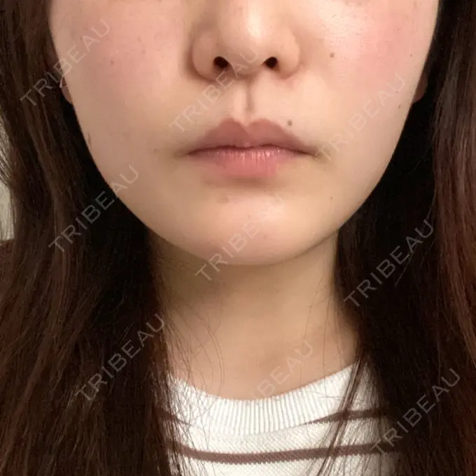 ボトックス（あご） / ボトックス（エラ・小顔） TCB東京中央美容外科 仙台駅前院 BEFORE メイン用