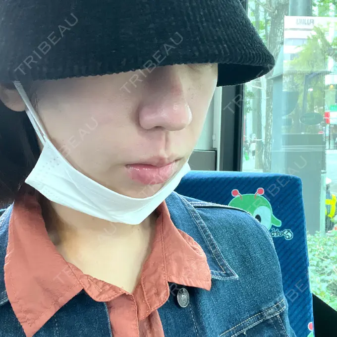 エレクトロポレーション / 毛穴洗浄（ハイドラフェイシャルなど） / ヴェルヴェットスキン ミニマムスキンクリニック池袋 BEFORE メイン用