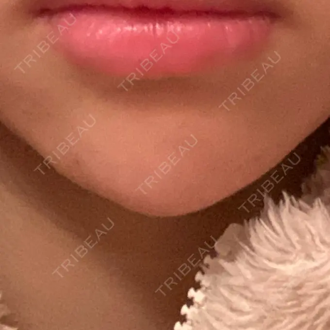 ボトックス（あご） 湘南美容クリニック 金山院 BEFORE メイン用