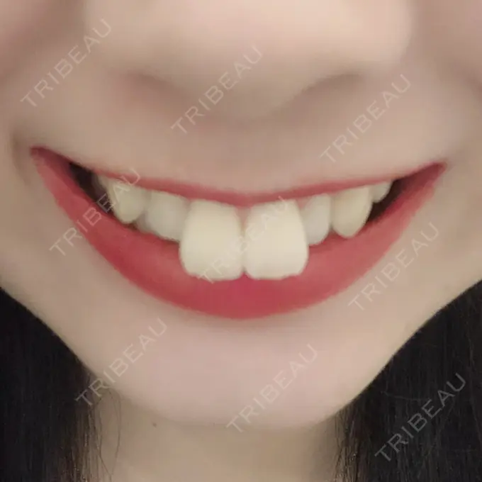 セラミック 東京美容外科 赤坂院 BEFORE メイン用